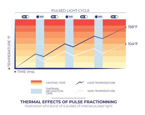 thermal effects of pulse fractionning IPL SHR